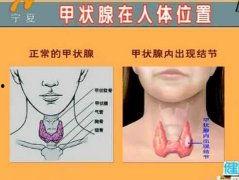 甲亢的位置图片,图解甲亢病变位置与特征